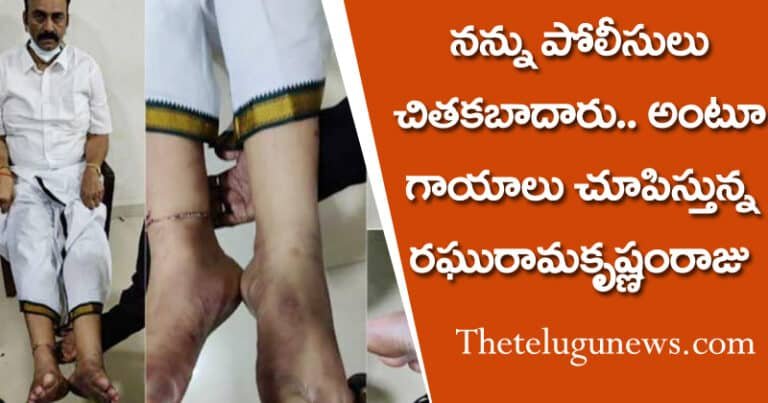 నన్ను పోలీసులు చితకబాదారు.. అంటూ గాయాలు చూపిస్తూ న్యాయమూర్తికి రఘురామకృష్ణంరాజు ఫిర్యాదు