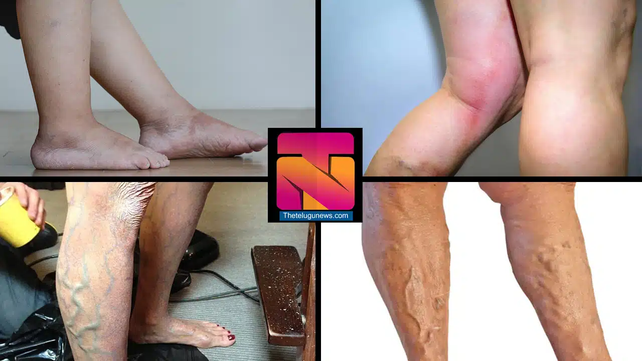 LEG PROBLEMS