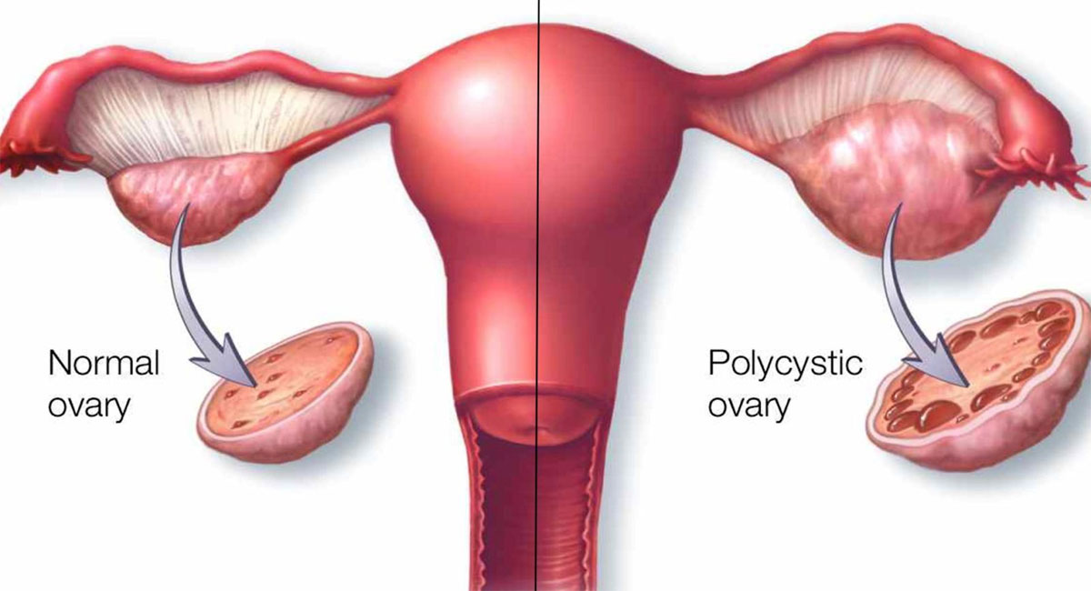 polycystic ovary syndrome