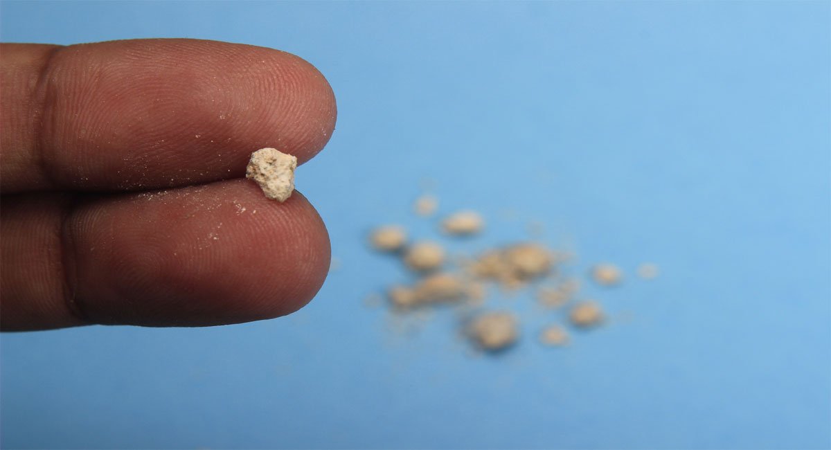 kidney stones people should avoid these foods