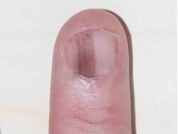 your fingernails tell ofter covid