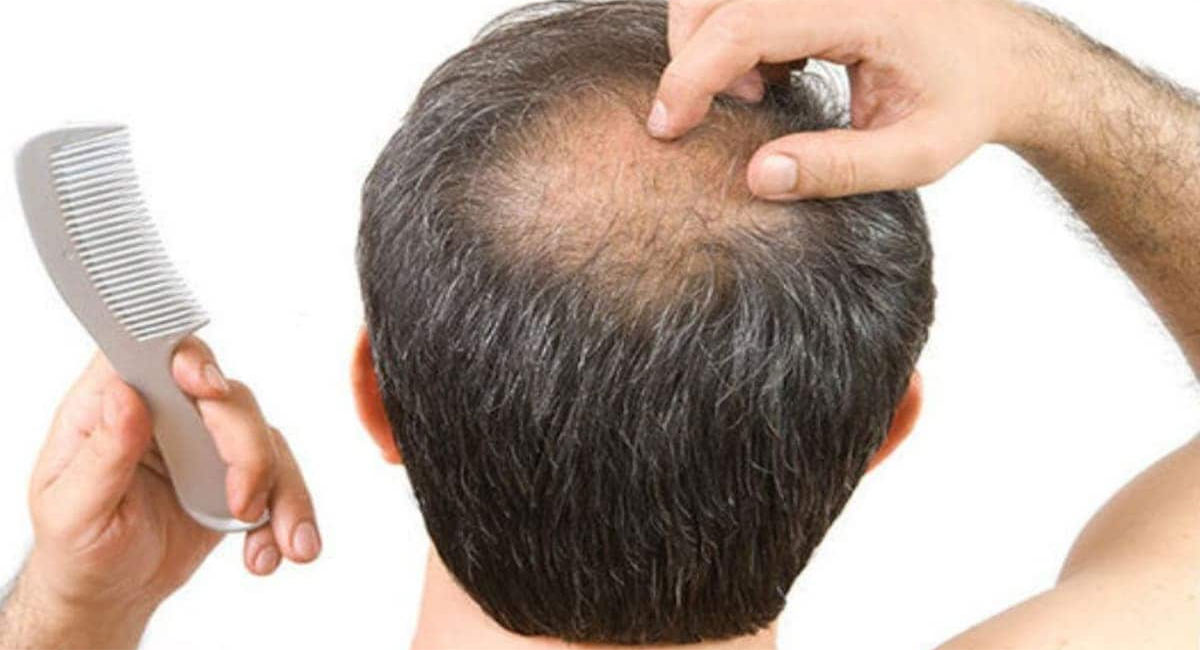 bald head home remedies with mango seed
