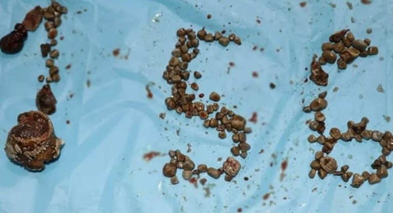 Kidney stones : వామ్మో.. కిడ్నీలో 156 రాళ్లు.. 3 గంటలు శ్రమించిన డాక్టర్లు..!