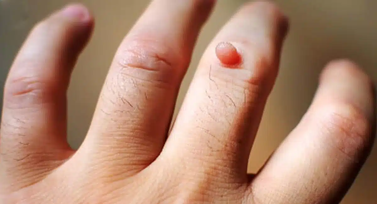 home remedy for remove warts