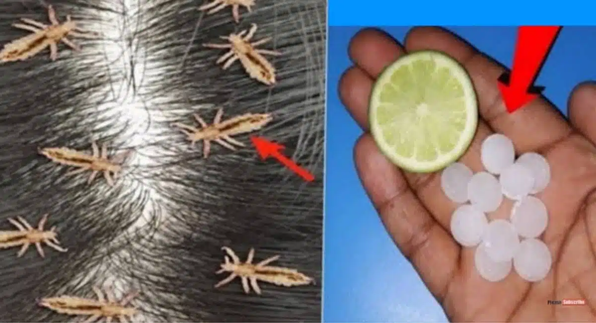 Hair Benefits lice removal home remedies
