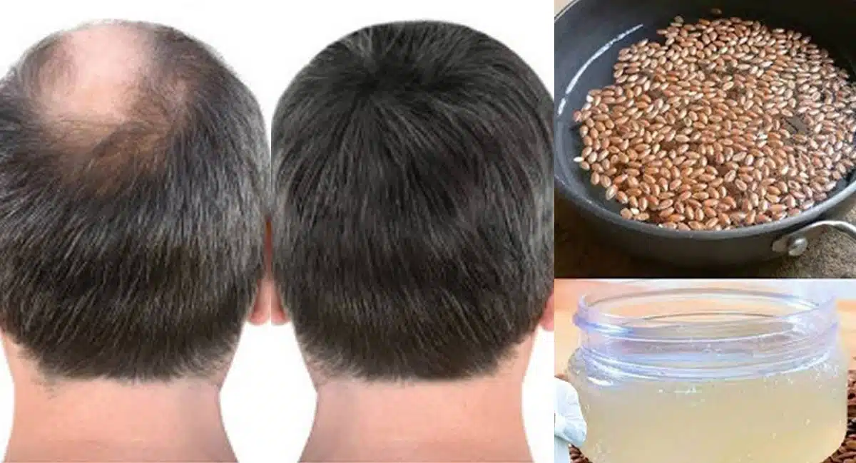 Hair Tips For Bald Head Of Some Foods In Telugu