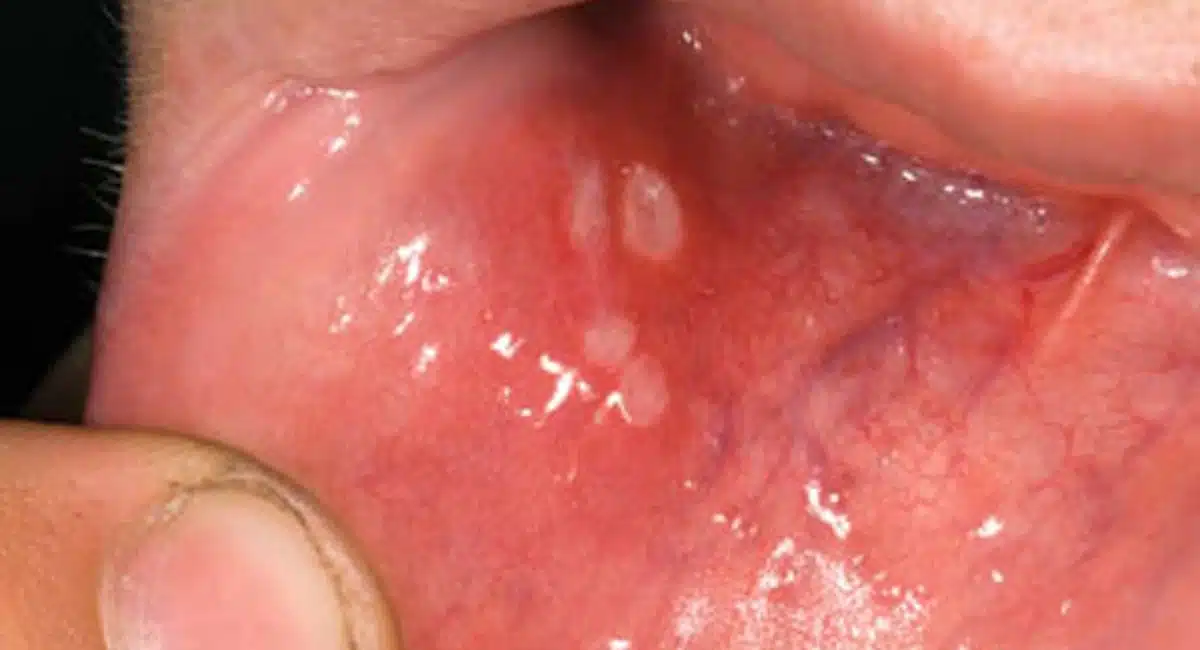 mouth ulcers kitchen remedies to heal canker sores