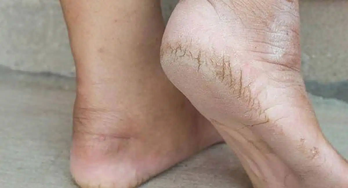 Health Tips in effective home remedied for cracked heels