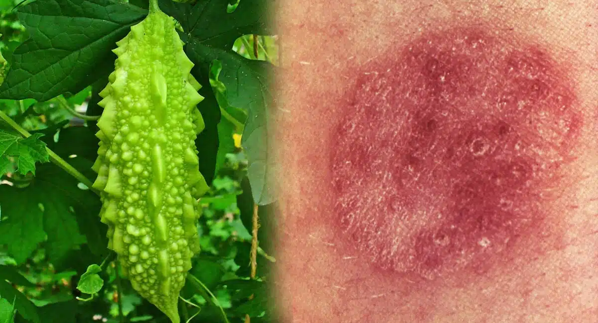 bitter melon uses for fungal infevtion