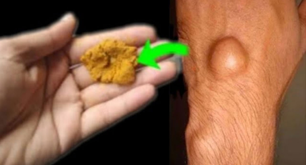 Health Benefits : లిపోమా నుంచి రిలీఫ్.. కావాలా.. ఇలా చేస్తే కొన్ని రోజుల్లోనే క‌ణ‌తులు మాయం