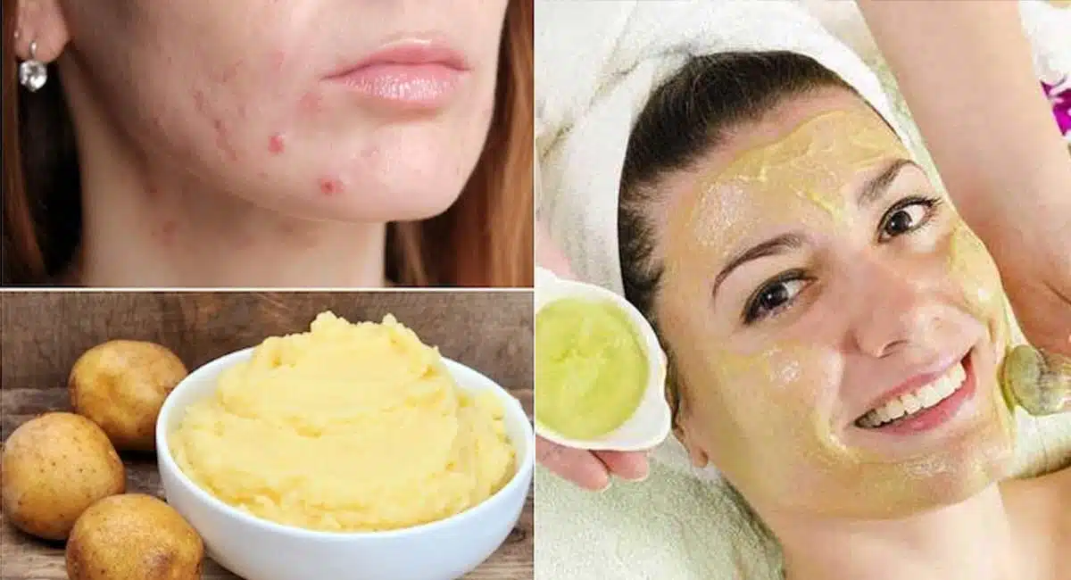 Beauty Tips in Potato Face Mask