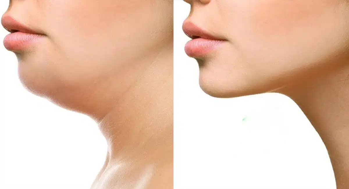 Health Benefits to reduce chin fat in week days