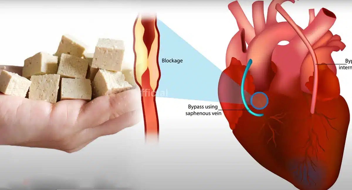 Health Benefits in protein rich foods reduce ovarian cysts SOYA BEANS