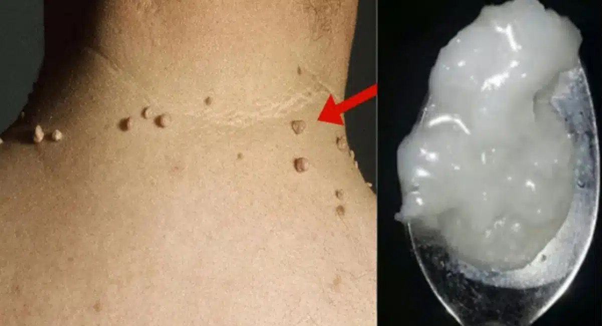 Health Benefits in home remedies for Skin tag removal