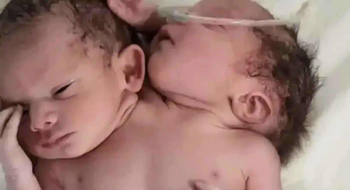 Scientific Reason what causes dicephalic parapagus twins