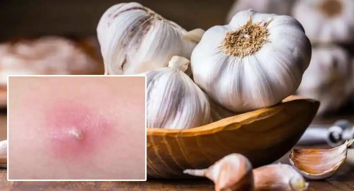 Helth Tips On sega bumps with garlic