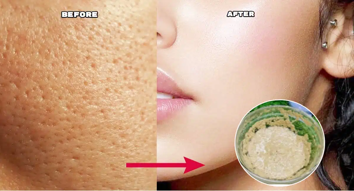 Beauty Tips home remedy for decrease openporse problem