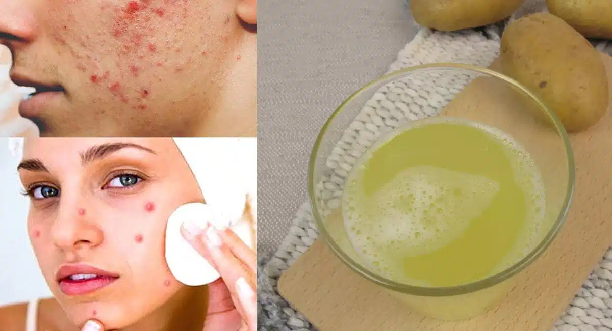 home made peel off mask for black heads