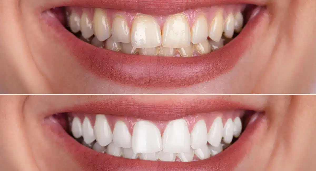 How to Whiten Teeth Tipsat home