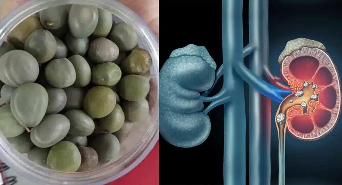 Health Benefits in Kidney Stones natural herbs Guilandina Bonduc