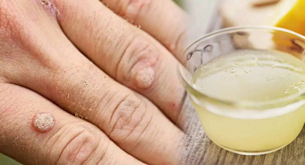 amazing Health Benefits for warts removing with out pain