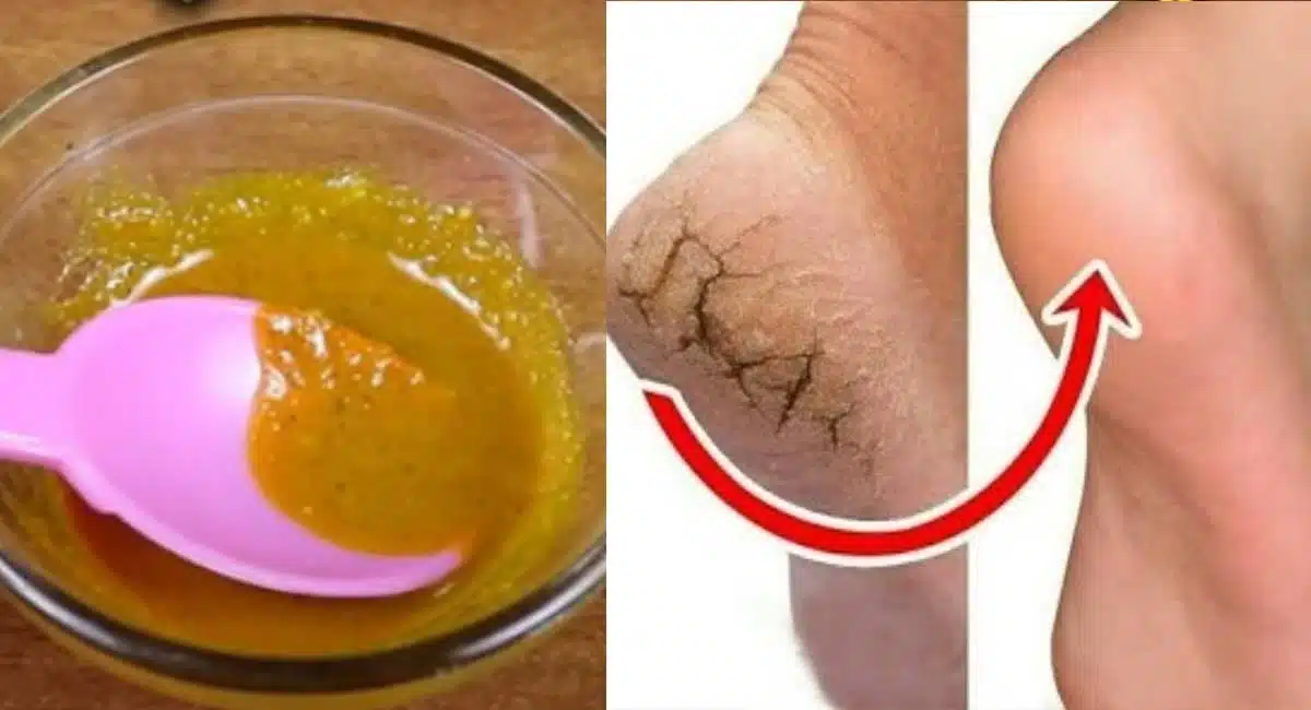 amazing Beauty Tips remedy for cracked heels