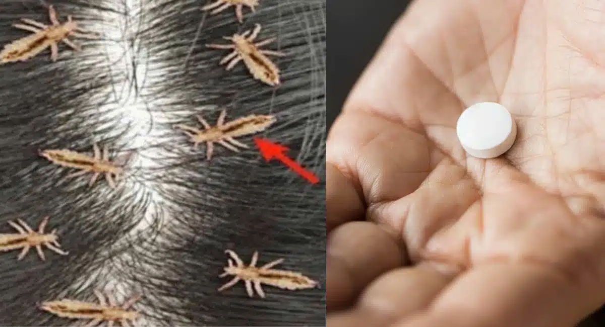 Hair Benefits how to get rid of head lice naturally ivermectin tablet