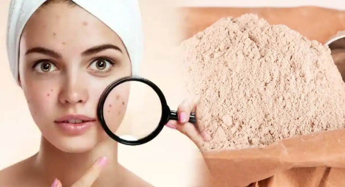amazing Beauty Tips on Pimples on the face