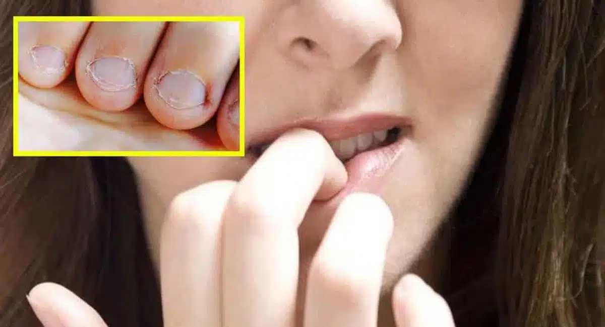 Life style biting your nails these is the bad habit