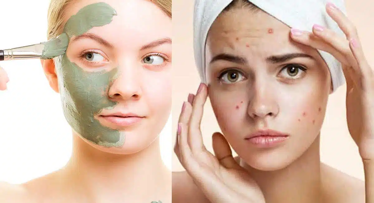 Beauty Tips to face pack to remove the black dots on the face