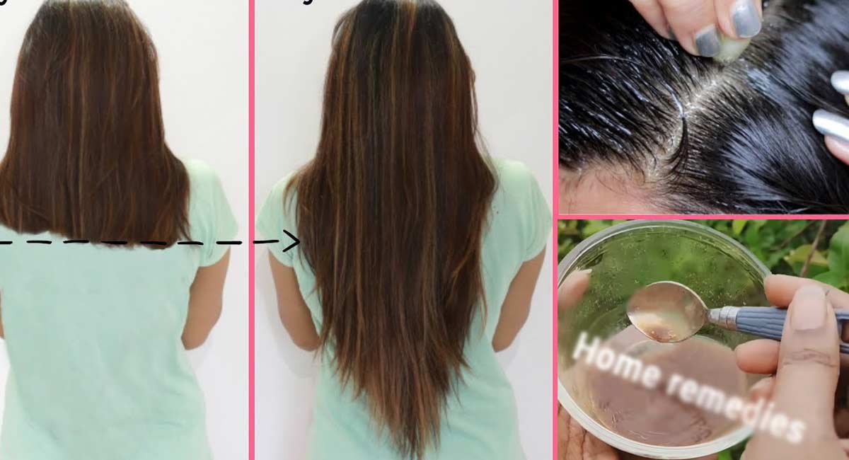 Hair Tips : మీ జుట్టు ఊడిపోతుందా.. అయితే ఈ సిరప్ రాసి చూడండి.. ఓడిన ప్రతి వెంట్రుక తిరిగి…