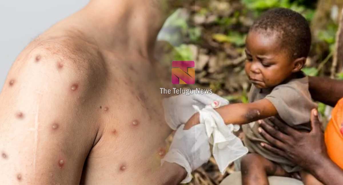 Monkeypox : మంకీ పాక్స్ ఎవరికీ వస్తుంది…? ఎలా వస్తుంది…?