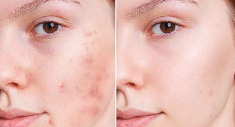Beauty Tips : ముఖంపై మొటిమలు పోవాలంటే… ఇలా చేయాలి…