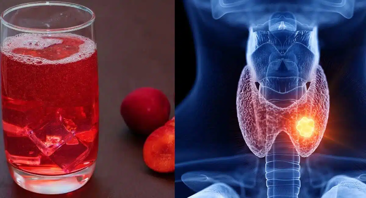 Thyroid Can Be Cured Easily