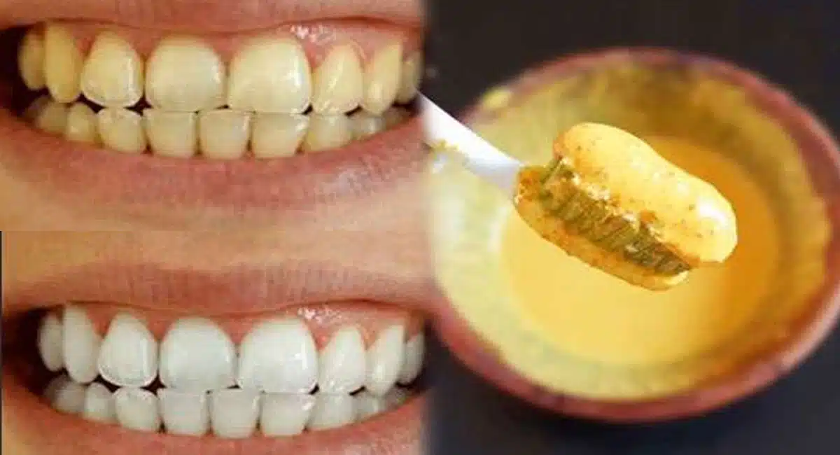 Health Tips these Home remedy for teeth