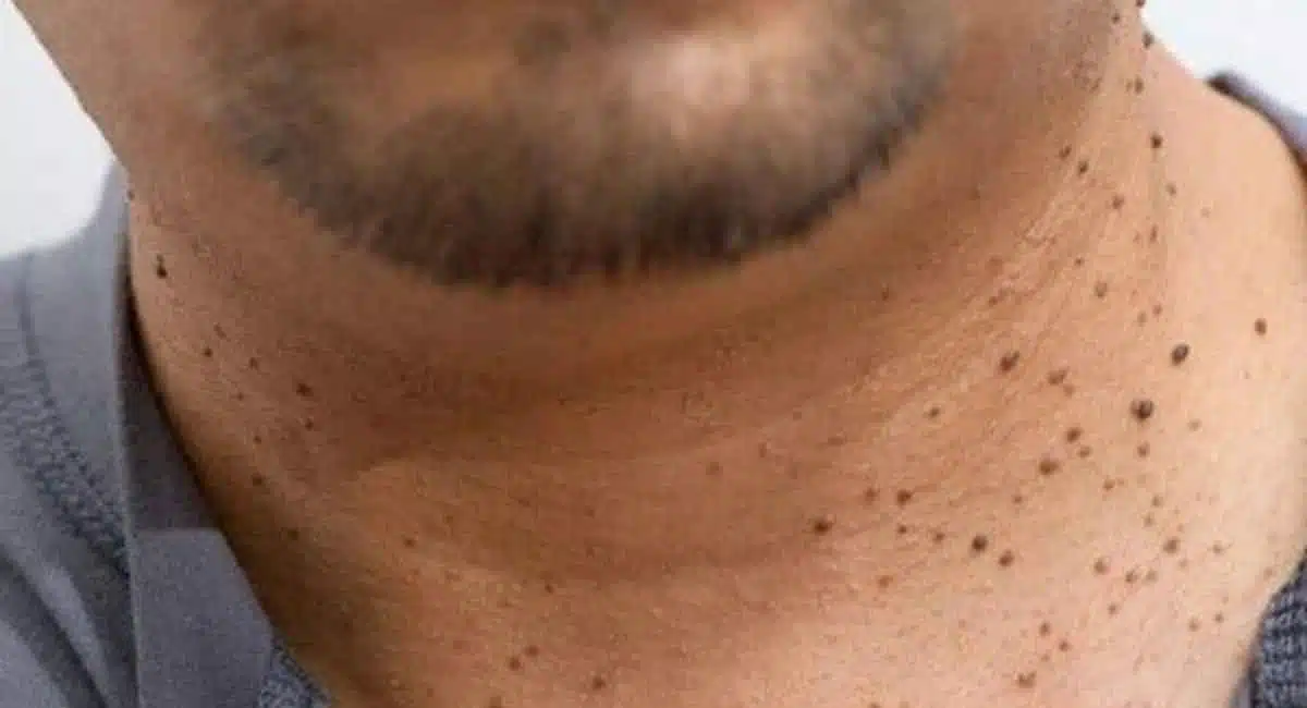Health Tips for warts Use tip to your skin