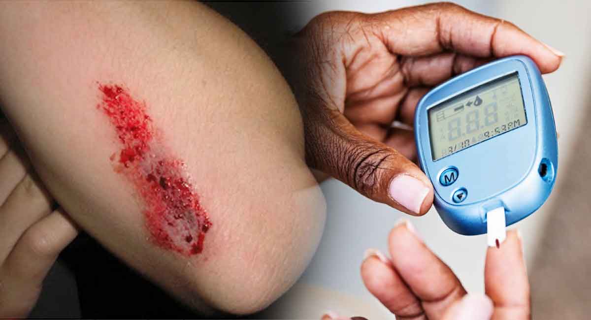 Diabetes : డయాబెటిస్ బాధితులకు గాయాలు తగ్గిపోవడానికి ఎక్కువ సమయం ఎందుకు పడుతుందో మీకు తెలుసా.?