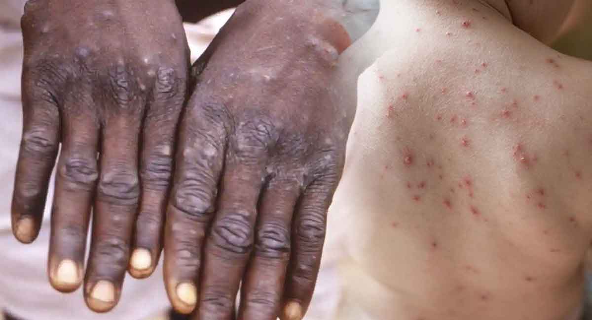 Monkeypox – Chickenpox : మంకీ ఫాక్స్, చికెన్ ఫాక్స్ రెండింటికి తేడా ఏంటి…? ఎలా గుర్తించాలి…?