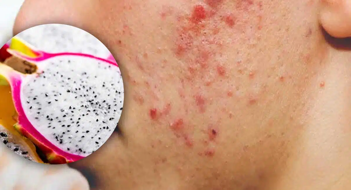 Beauty Tips Face pack for pimples In Telugu