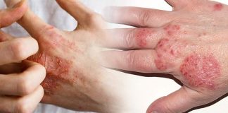 Skin Care Not all allergies are Eczema.. Know Some Health Tips