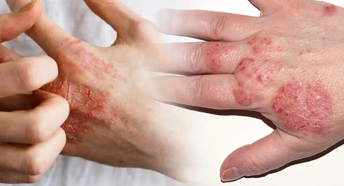 Skin Care Not all allergies are Eczema.. Know Some Health Tips