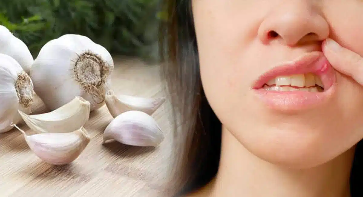 Health tips these Home remedy for Mouth ulcers