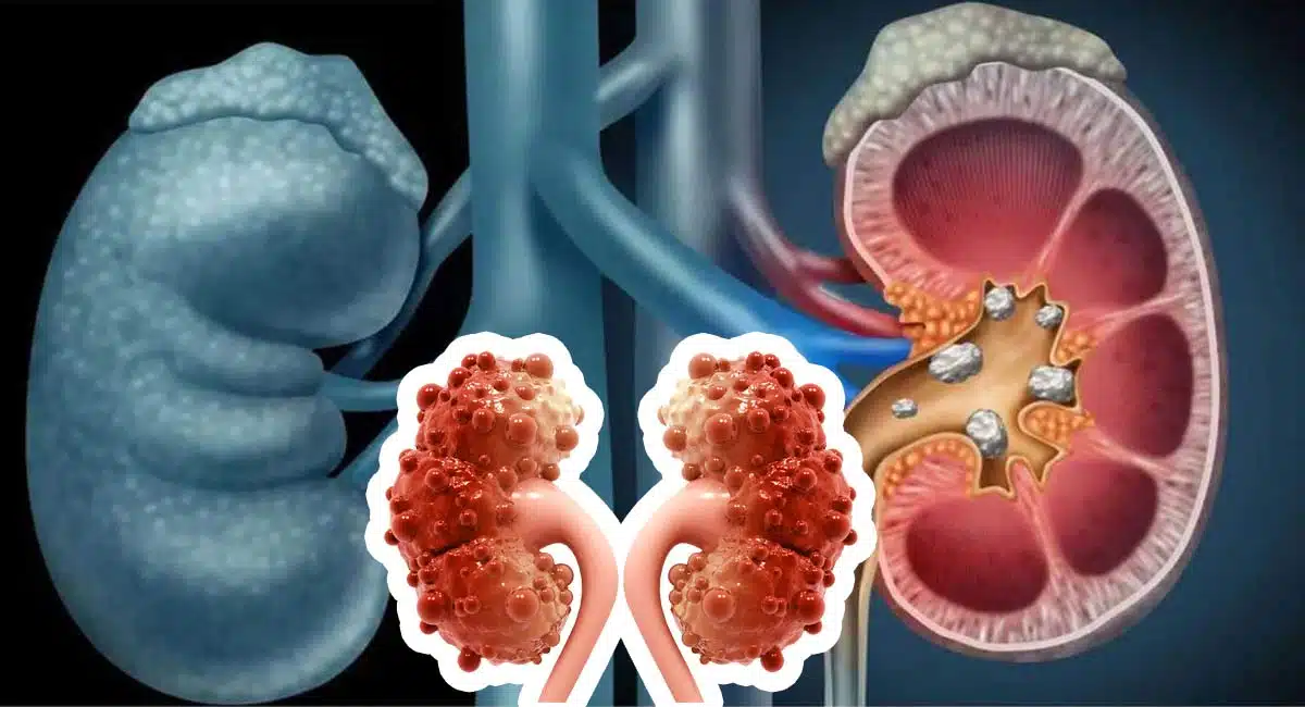 Health Tips & symptoms of Polycystic Kidney Disease