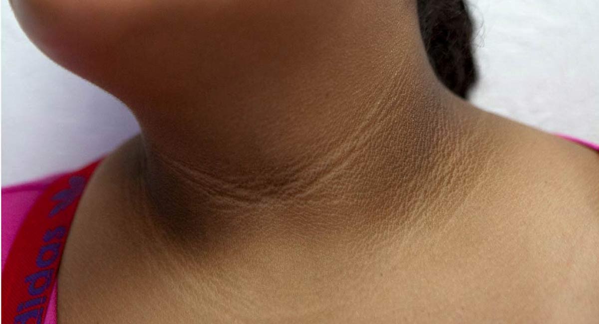 Health Tips Black lines on the neck should be Precautions
