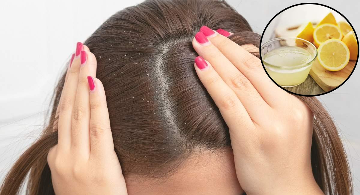 Hair Tips : ఈ చలికాలంలో చుండ్రుతో బాధపడుతున్నారా..? నిమ్మరసంతో ఇలా చేయండి చాలు…!