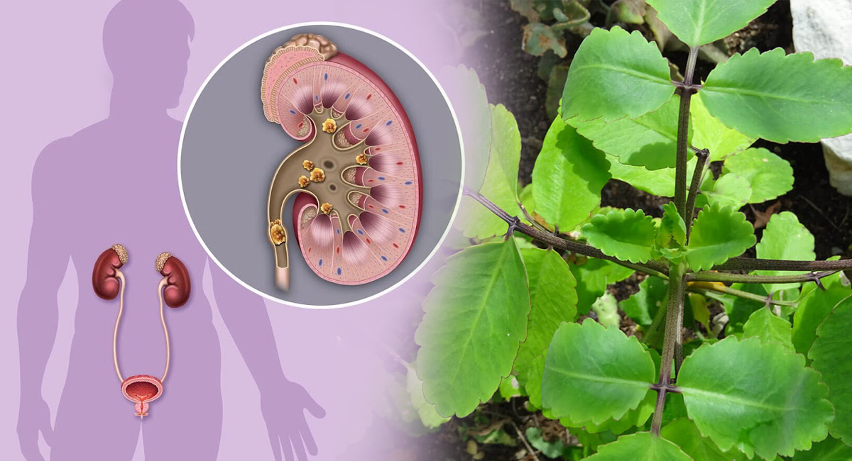 Health Tips on medicinal leaf removes kidney stones