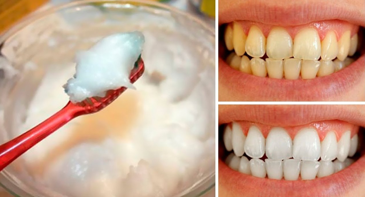 Tooth Tips : కేవలం రెండు స్పూన్లతో.. పసుపు రంగులో ఉన్న పళ్ళు తెలుపు రంగులోకి వస్తాయి…!