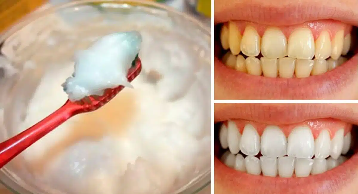 Tooth Tips to whiten your teeth reduces dental cavities
