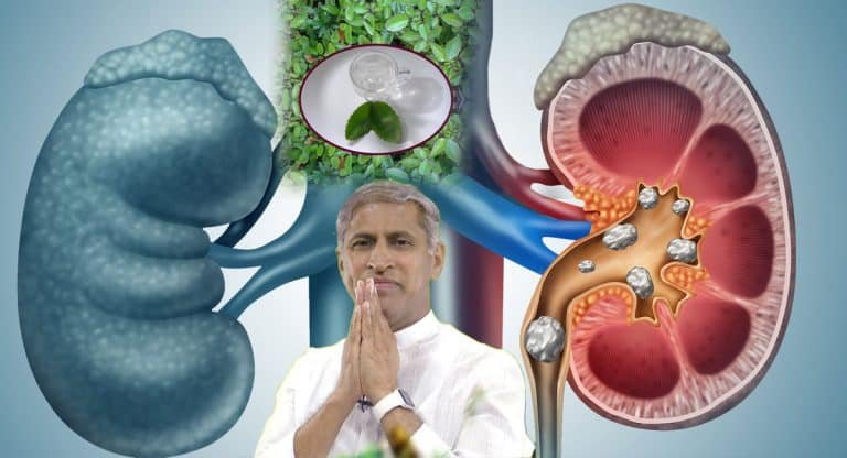 Kidney Stones : కిడ్నీలో రాళ్లు గుట్టలుగా ఉన్న 5 డేస్ లో సర్దుకోవాల్సిందే…!