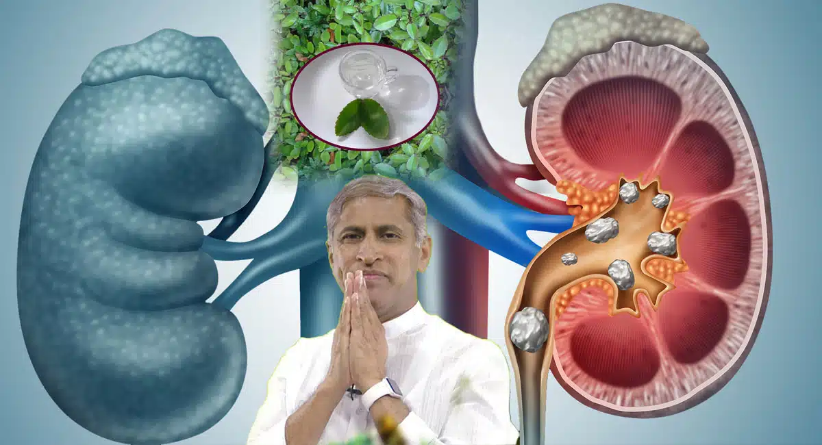 Kidney stones should be removed in five days